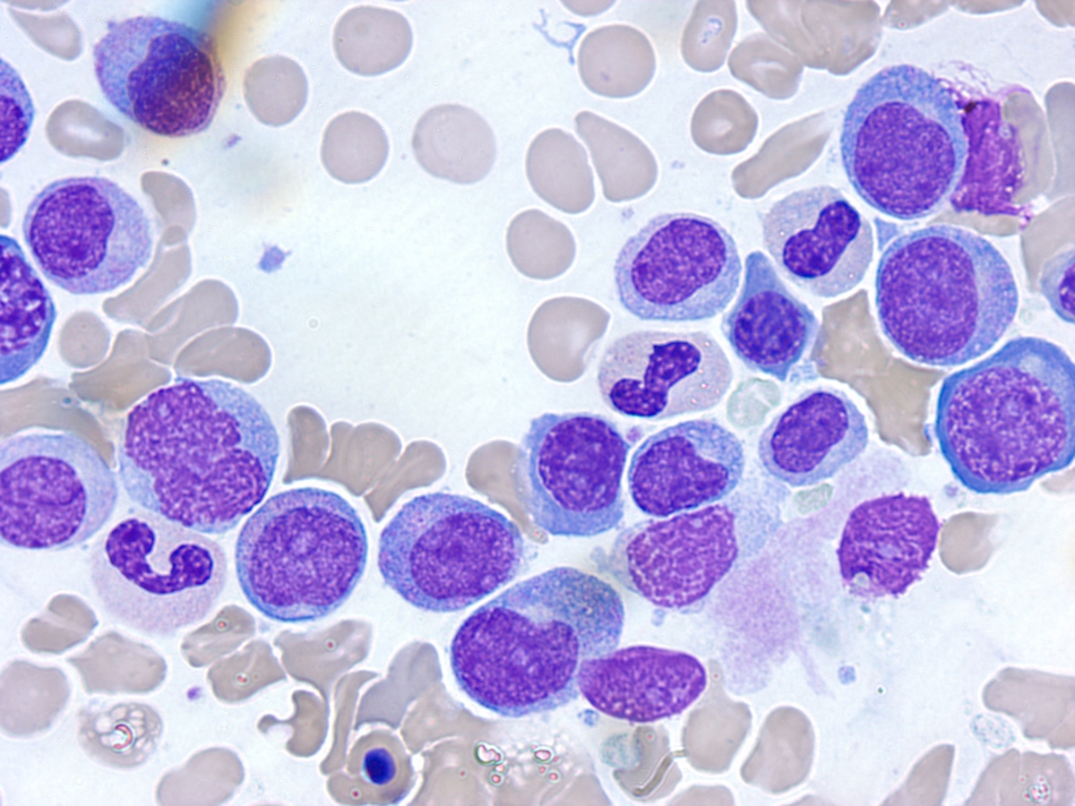 Bone marrow aspirate (Wright stain); Monoblasts, 1000x